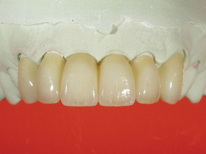 implant abutments